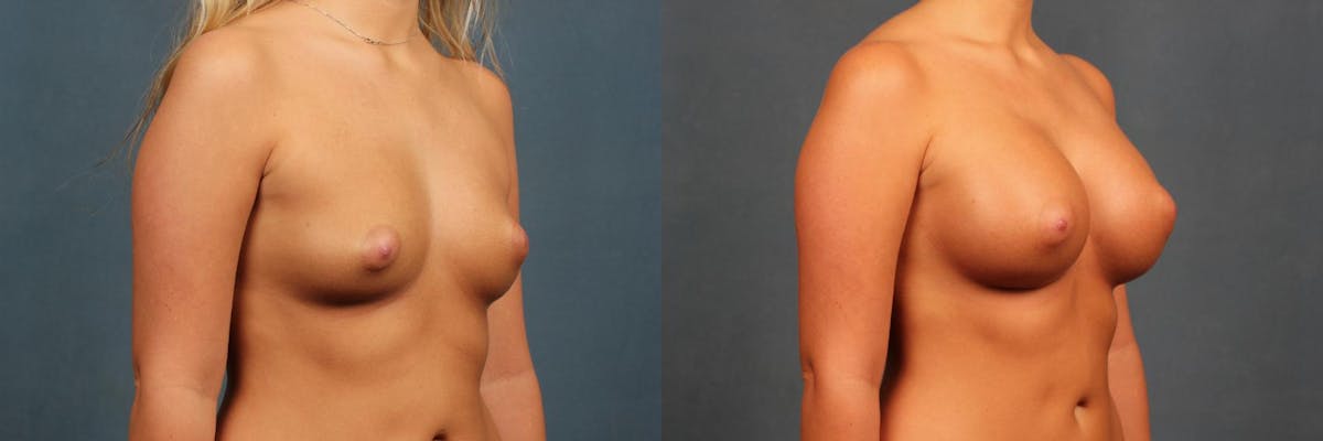 Enlargement - Silicone Before & After Gallery - Patient 157669 - Image 2