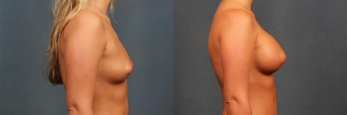 Enlargement - Silicone Before & After Gallery - Patient 157669 - Image 3