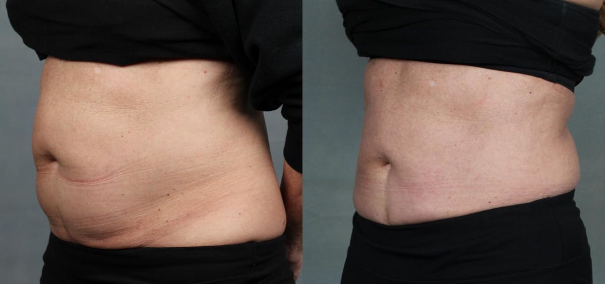 EMSculpt Before & After Gallery - Patient 287011 - Image 3