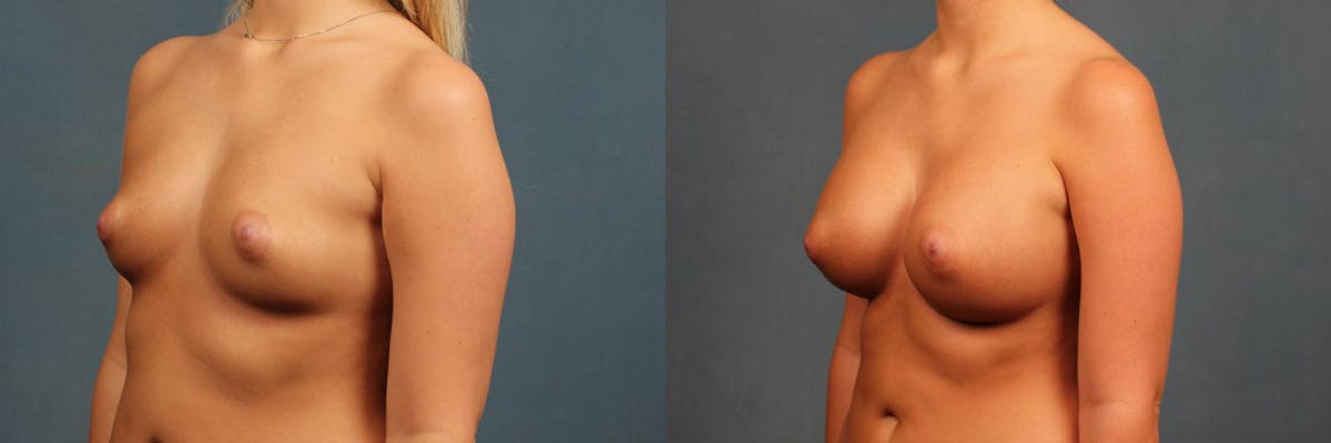 Enlargement - Silicone Before & After Gallery - Patient 157669 - Image 4