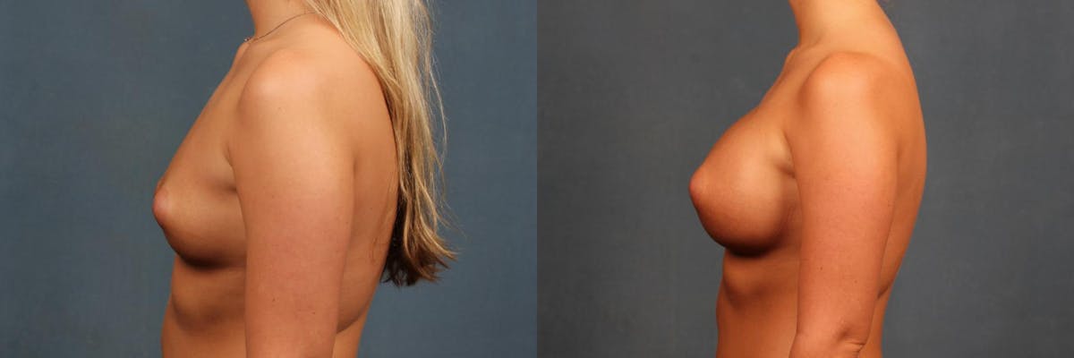 Enlargement - Silicone Before & After Gallery - Patient 157669 - Image 5