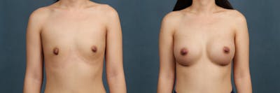 Enlargement - Silicone Before & After Gallery - Patient 146504 - Image 1
