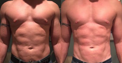 EMSculpt Before & After Gallery - Patient 379993 - Image 1