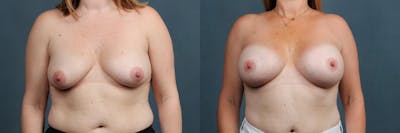 Enlargement - Silicone Before & After Gallery - Patient 140299 - Image 1