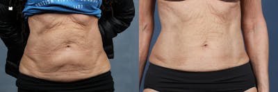 EMSculpt Before & After Gallery - Patient 153513 - Image 1