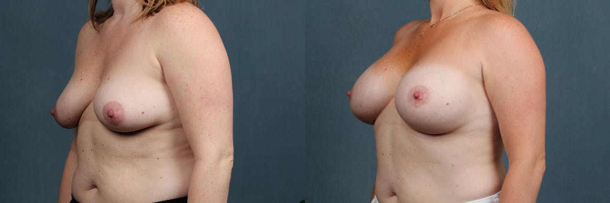Enlargement - Silicone Before & After Gallery - Patient 140299 - Image 2