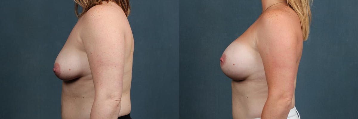 Enlargement - Silicone Before & After Gallery - Patient 140299 - Image 3