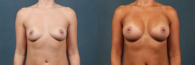 Enlargement - Silicone Before & After Gallery - Patient 103781 - Image 1
