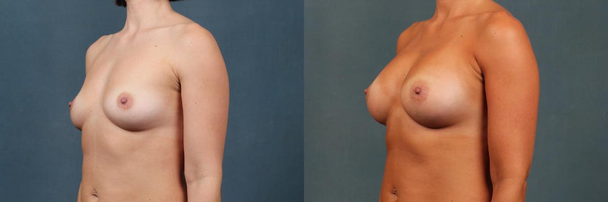 Enlargement - Silicone Before & After Gallery - Patient 103781 - Image 2