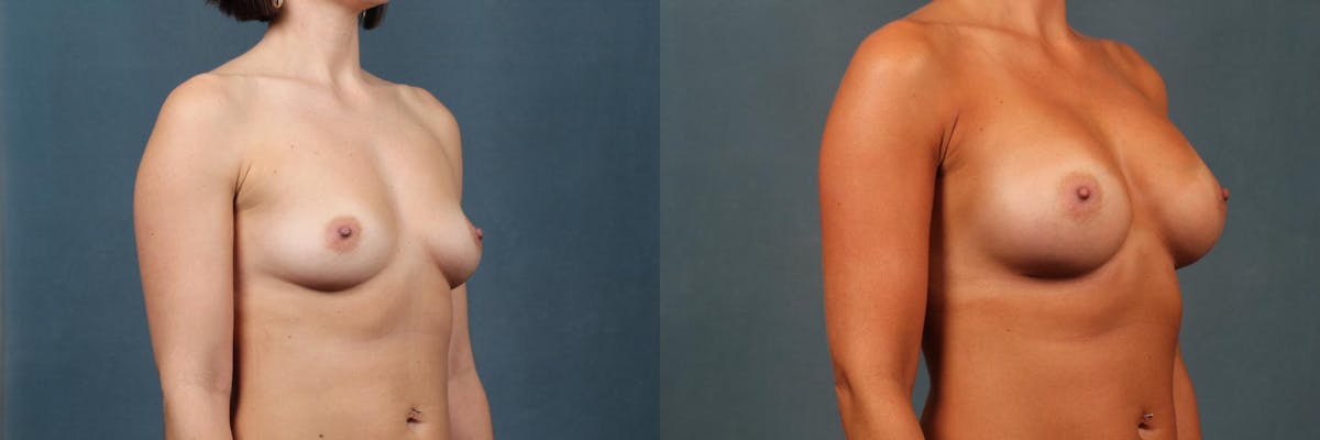 Enlargement - Silicone Before & After Gallery - Patient 103781 - Image 3