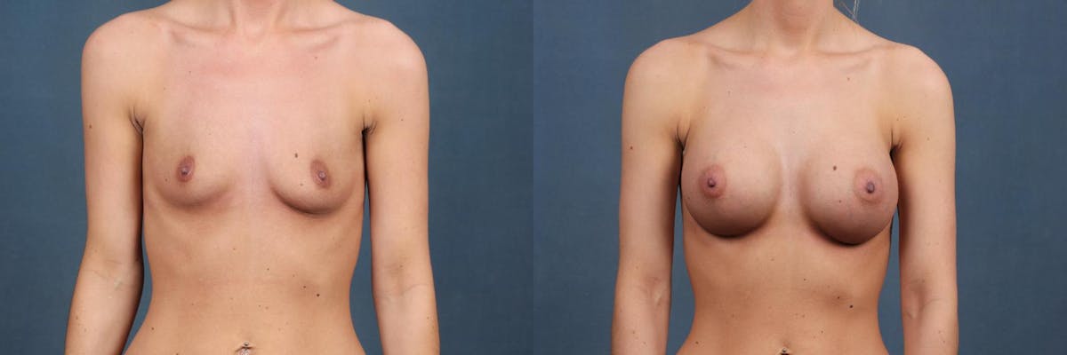 Enlargement - Silicone Before & After Gallery - Patient 410994 - Image 1