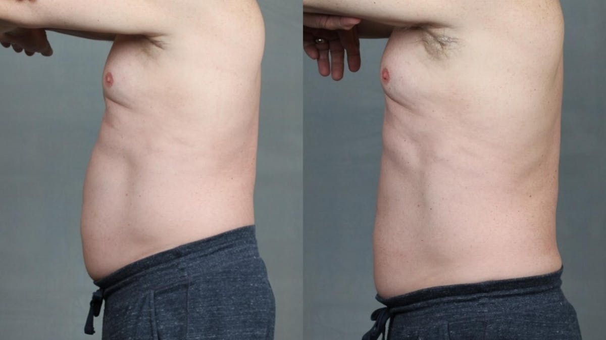 TruSculpt Before & After Gallery - Patient 404723 - Image 1