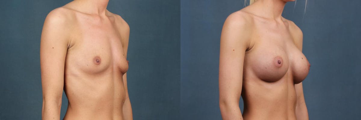 Enlargement - Silicone Before & After Gallery - Patient 410994 - Image 2