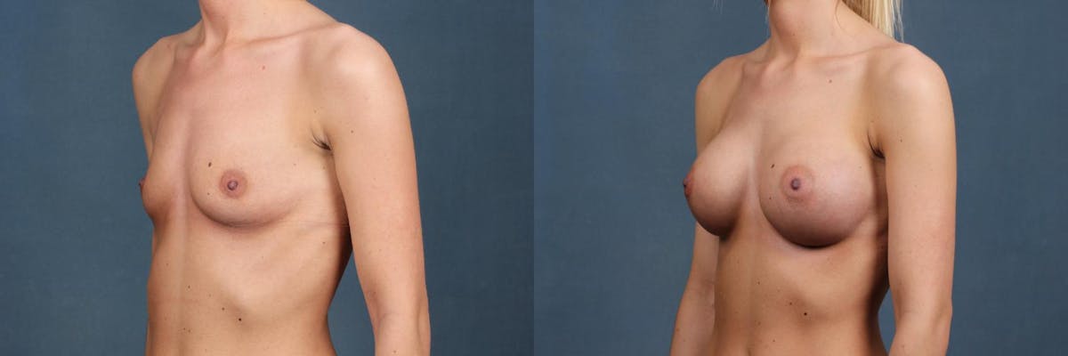 Enlargement - Silicone Before & After Gallery - Patient 410994 - Image 4
