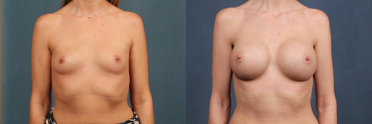 Enlargement - Silicone Before & After Gallery - Patient 147508 - Image 1