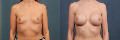 Enlargement - Silicone Before & After Gallery - Patient 147508 - Image 1