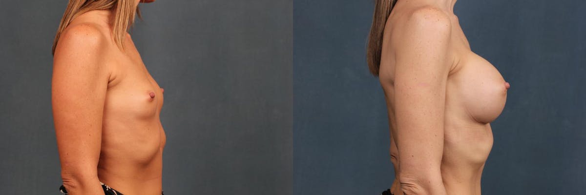 Enlargement - Silicone Before & After Gallery - Patient 147508 - Image 3