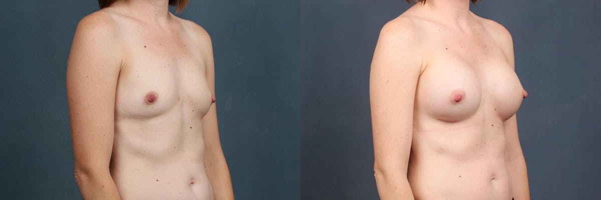 Enlargement - Silicone Before & After Gallery - Patient 125456 - Image 3