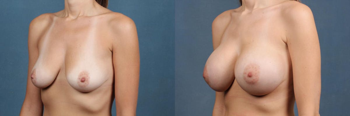 Enlargement - Silicone Before & After Gallery - Patient 117467 - Image 2