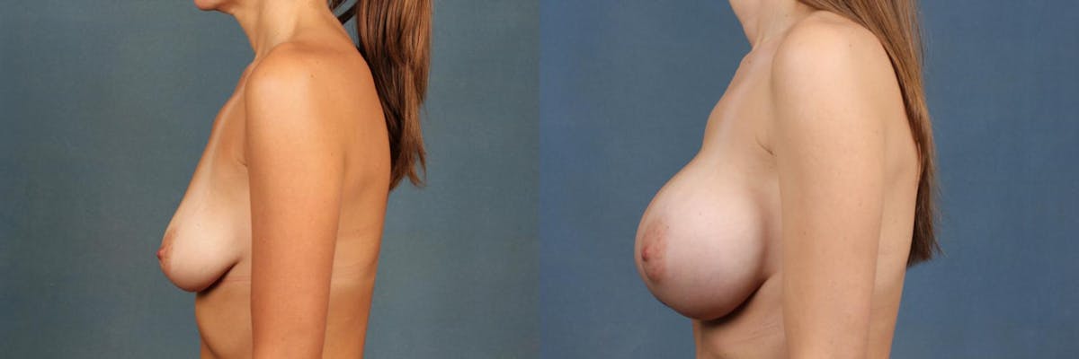 Enlargement - Silicone Before & After Gallery - Patient 117467 - Image 3