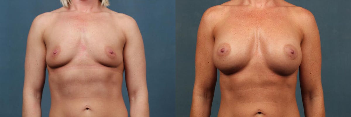 Enlargement - Silicone Before & After Gallery - Patient 335106 - Image 1
