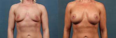 Enlargement - Silicone Before & After Gallery - Patient 335106 - Image 1