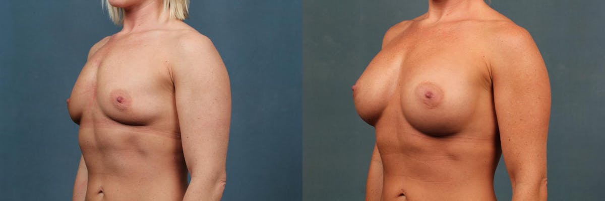 Enlargement - Silicone Before & After Gallery - Patient 335106 - Image 2