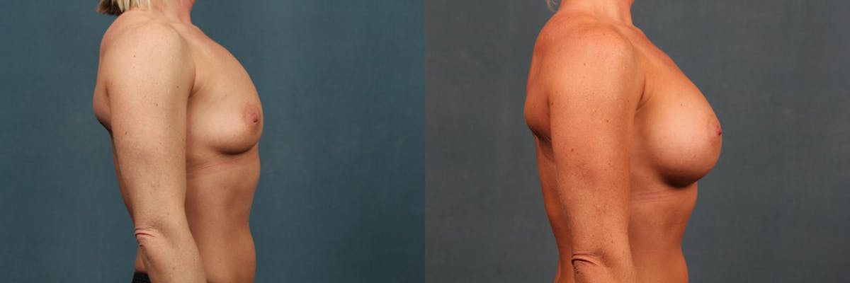 Enlargement - Silicone Before & After Gallery - Patient 335106 - Image 3