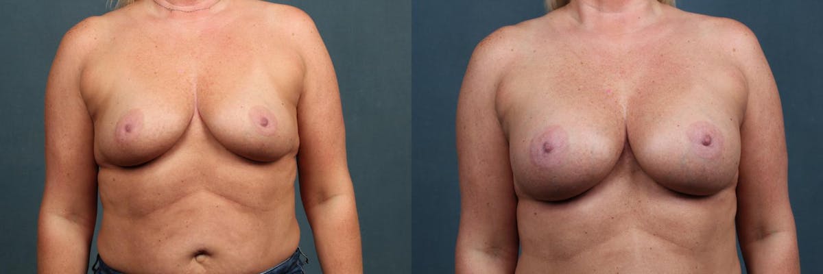 Enlargement - Silicone Before & After Gallery - Patient 351476 - Image 1