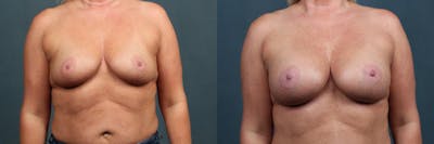 Enlargement - Silicone Before & After Gallery - Patient 351476 - Image 1
