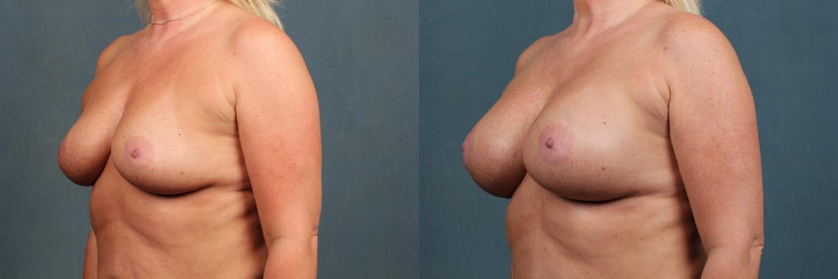 Enlargement - Silicone Before & After Gallery - Patient 351476 - Image 2