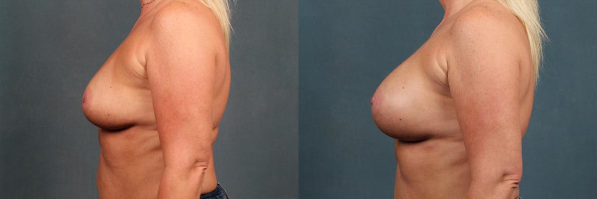 Enlargement - Silicone Before & After Gallery - Patient 351476 - Image 3