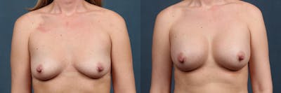 Enlargement - Silicone Before & After Gallery - Patient 323349 - Image 1