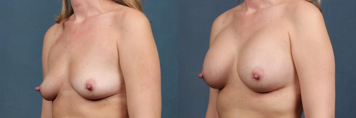 Enlargement - Silicone Before & After Gallery - Patient 323349 - Image 2