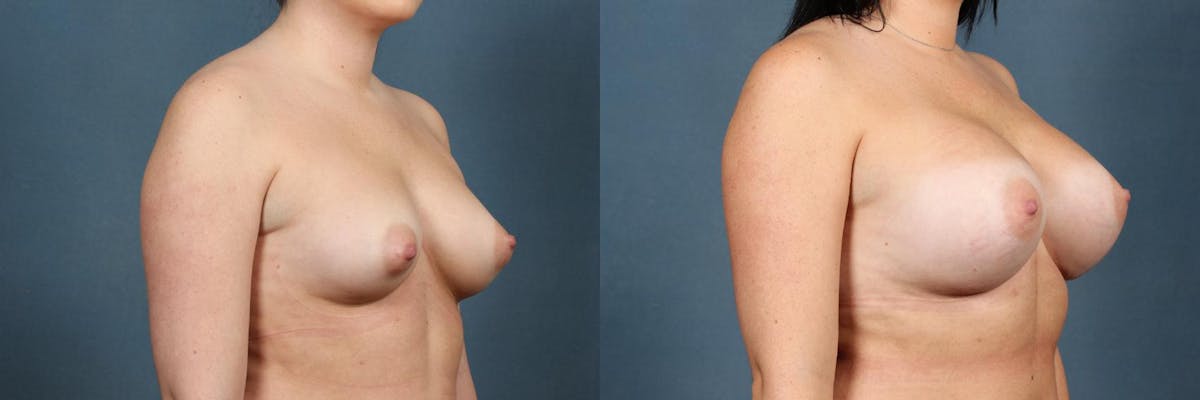 Enlargement - Silicone Before & After Gallery - Patient 379297 - Image 2