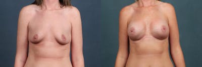 Enlargement - Silicone Before & After Gallery - Patient 295772 - Image 1