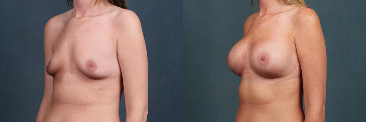 Enlargement - Silicone Before & After Gallery - Patient 295772 - Image 2