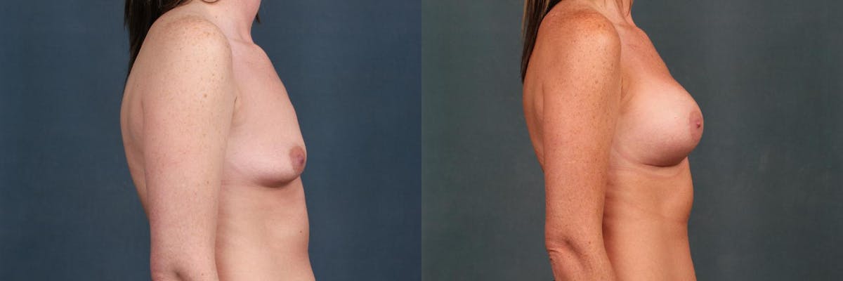 Enlargement - Silicone Before & After Gallery - Patient 295772 - Image 3