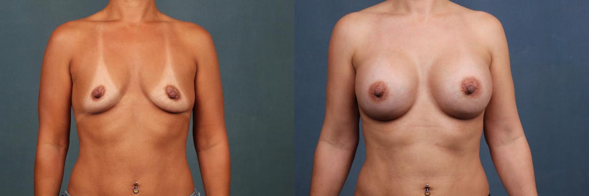 Enlargement - Silicone Before & After Gallery - Patient 335191 - Image 1