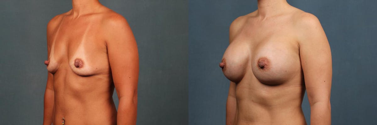 Enlargement - Silicone Before & After Gallery - Patient 335191 - Image 2
