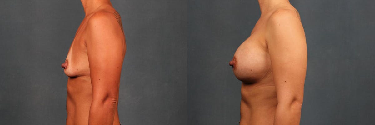 Enlargement - Silicone Before & After Gallery - Patient 335191 - Image 3