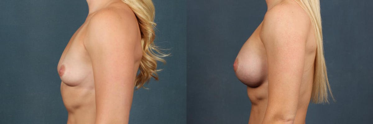 Enlargement - Silicone Before & After Gallery - Patient 198143 - Image 2