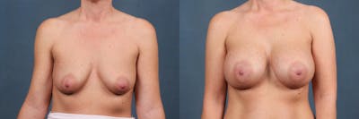 Enlargement - Silicone Before & After Gallery - Patient 266238 - Image 1