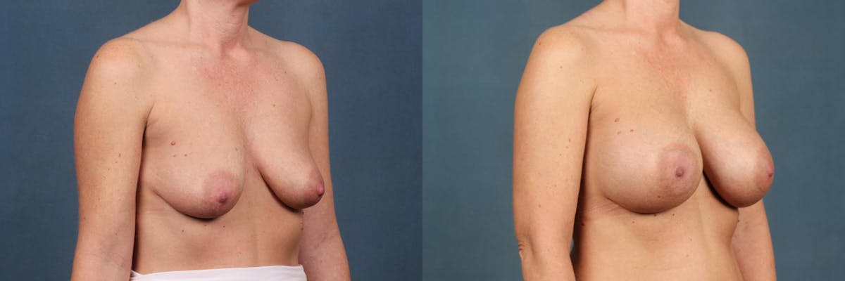 Enlargement - Silicone Before & After Gallery - Patient 266238 - Image 2