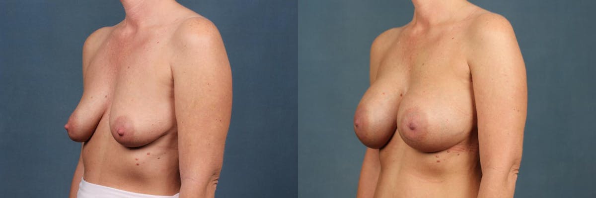 Enlargement - Silicone Before & After Gallery - Patient 266238 - Image 3