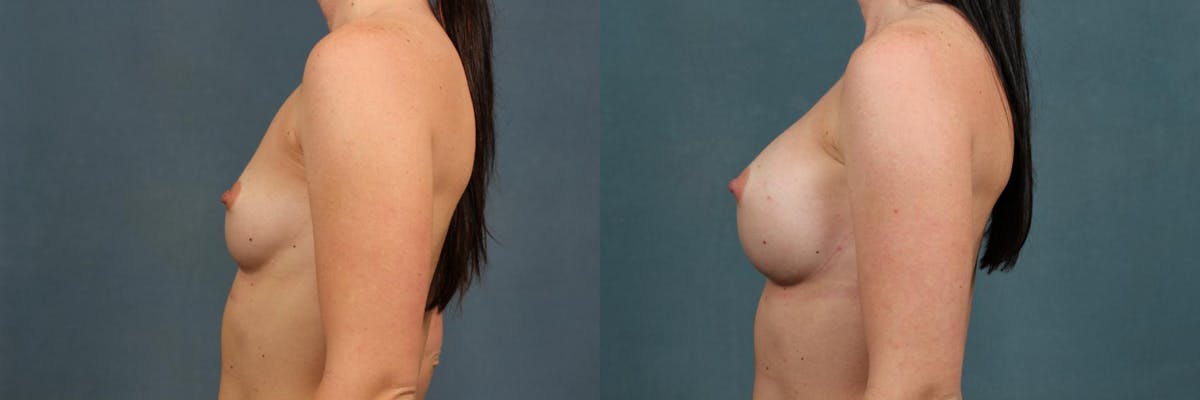 Enlargement - Silicone Before & After Gallery - Patient 181291 - Image 2