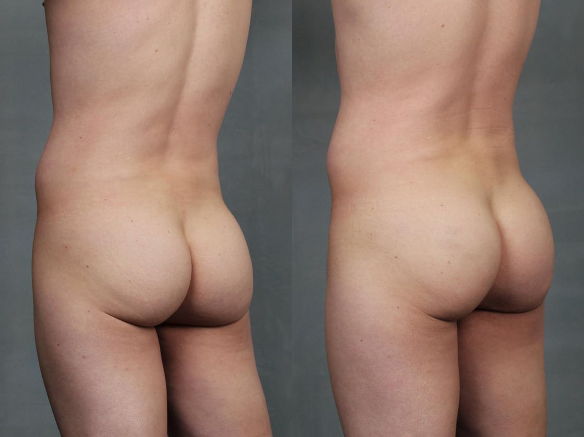 Sculptra for Buttocks Before & After Gallery - Patient 484943 - Image 1