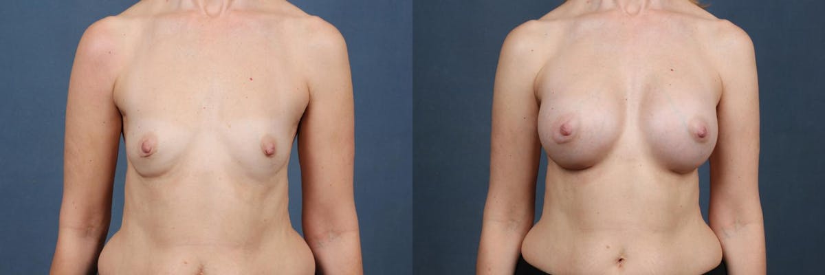 Enlargement - Silicone Before & After Gallery - Patient 454795 - Image 1