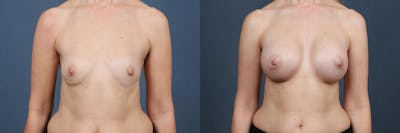 Enlargement - Silicone Before & After Gallery - Patient 454795 - Image 1