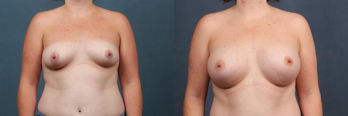 Enlargement - Silicone Before & After Gallery - Patient 415592 - Image 1